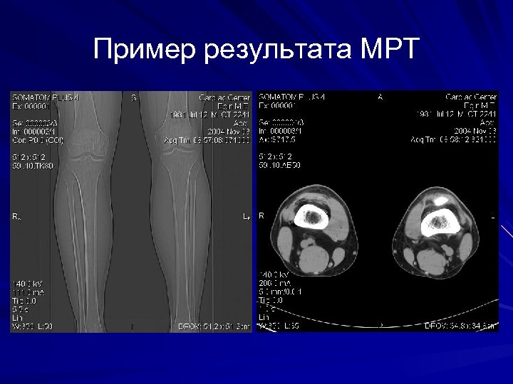 Пример результата МРТ 