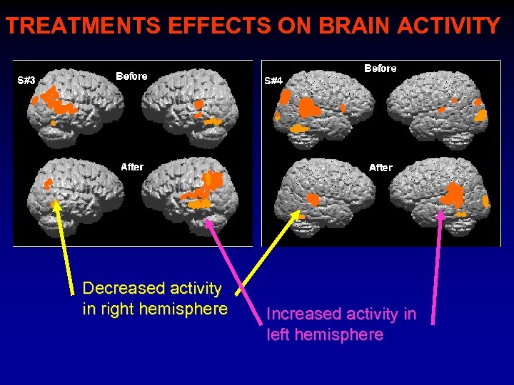 TREATMENTS EFFECTS ON BRAIN ACTIVITY Decreased activity in right hemisphere Increased activity in left