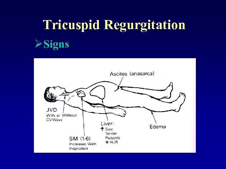 Tricuspid Regurgitation ØSigns 