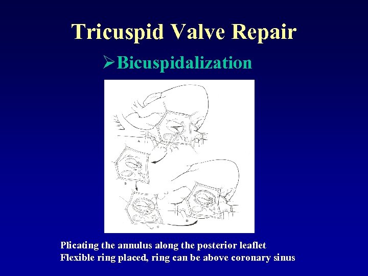 Tricuspid Valve Repair ØBicuspidalization Plicating the annulus along the posterior leaflet Flexible ring placed,