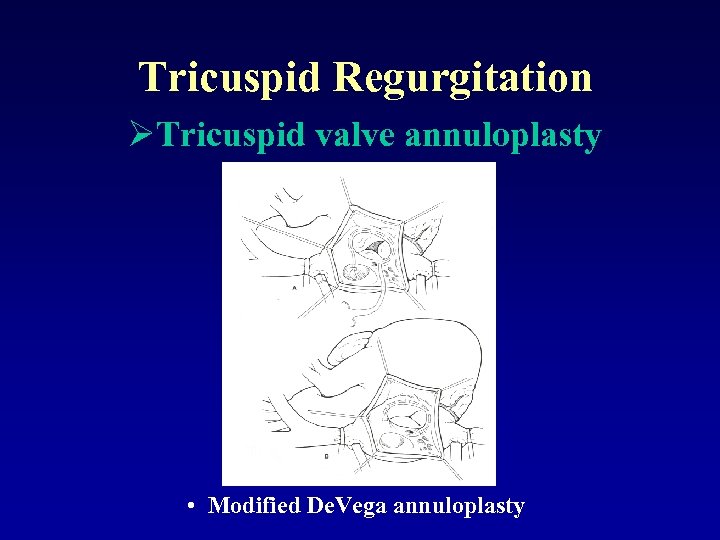 Tricuspid Regurgitation ØTricuspid valve annuloplasty • Modified De. Vega annuloplasty 