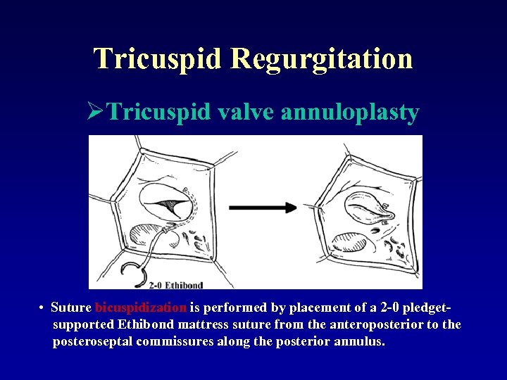 Tricuspid Regurgitation ØTricuspid valve annuloplasty • Suture bicuspidization is performed by placement of a