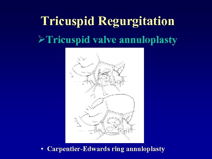 Tricuspid Regurgitation ØTricuspid valve annuloplasty • Carpentier-Edwards ring annuloplasty 