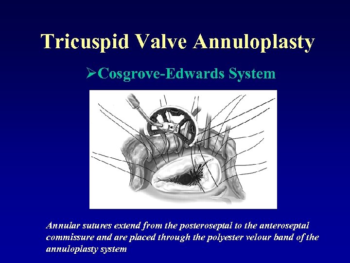 Tricuspid Valve Annuloplasty ØCosgrove-Edwards System Annular sutures extend from the posteroseptal to the anteroseptal