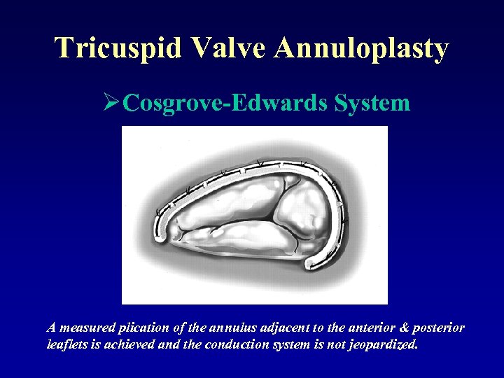 Tricuspid Valve Annuloplasty ØCosgrove-Edwards System A measured plication of the annulus adjacent to the