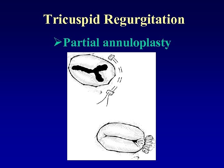 Tricuspid Regurgitation ØPartial annuloplasty 