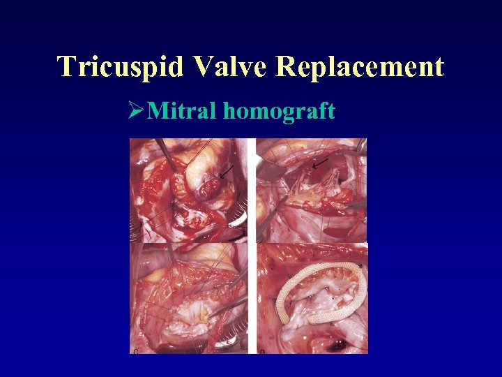 Tricuspid Valve Replacement ØMitral homograft 