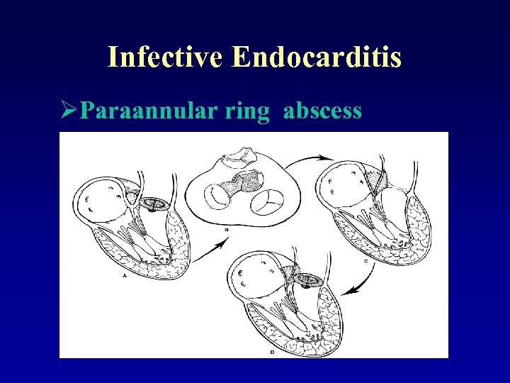 Infective Endocarditis ØParaannular ring abscess 