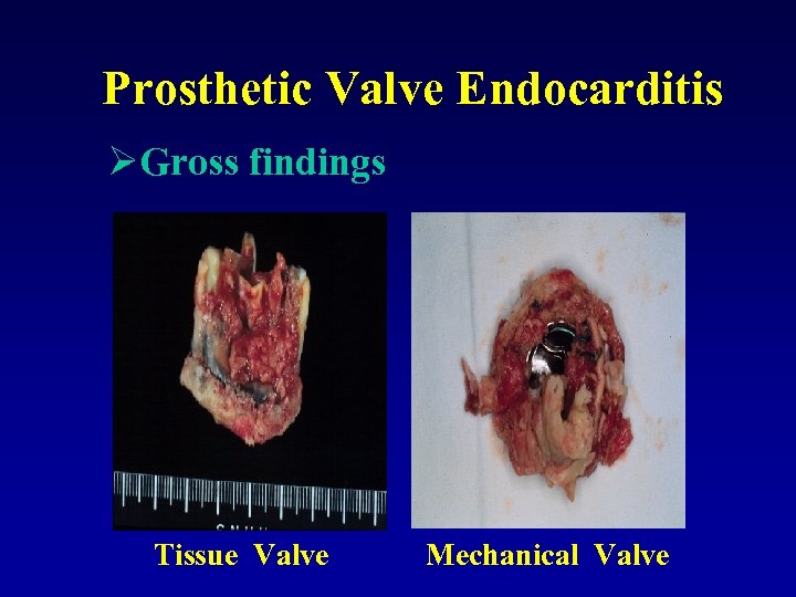 Prosthetic Valve Endocarditis ØGross findings Tissue Valve Mechanical Valve 