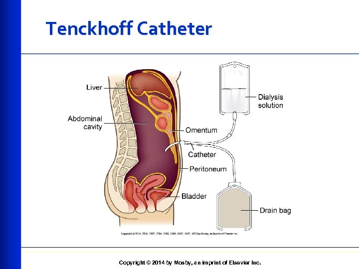Tenckhoff Catheter Copyright © 2014 by Mosby, an imprint of Elsevier Inc. 