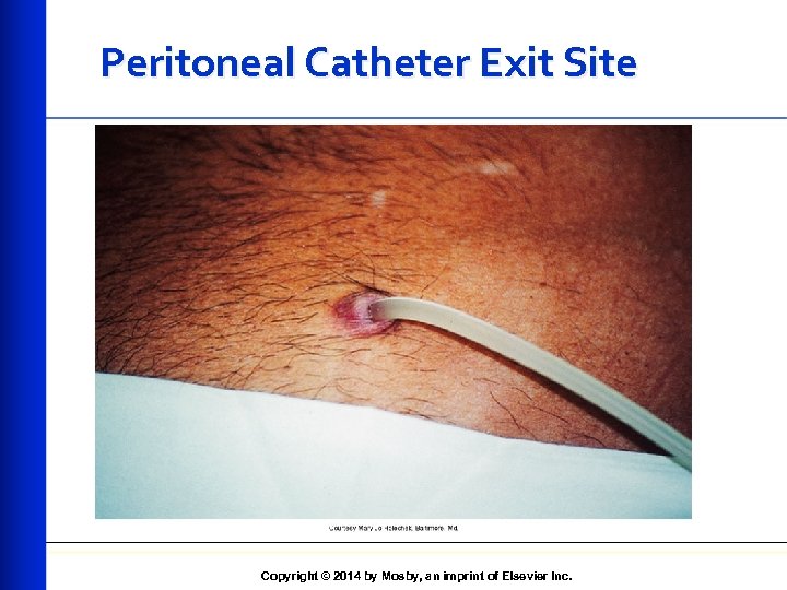 Peritoneal Catheter Exit Site Copyright © 2014 by Mosby, an imprint of Elsevier Inc.