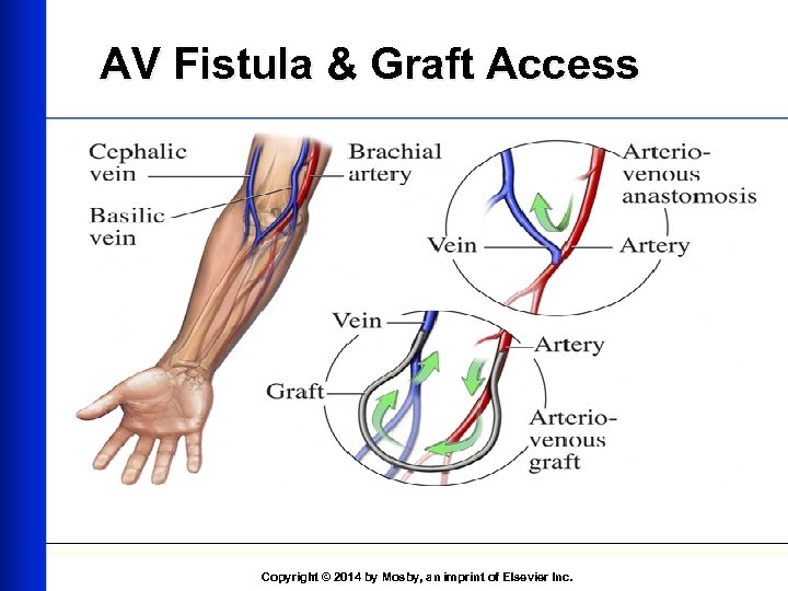 AV Fistula & Graft Access Copyright © 2014 by Mosby, an imprint of Elsevier