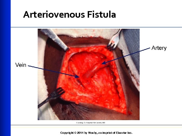 Arteriovenous Fistula Copyright © 2014 by Mosby, an imprint of Elsevier Inc. 