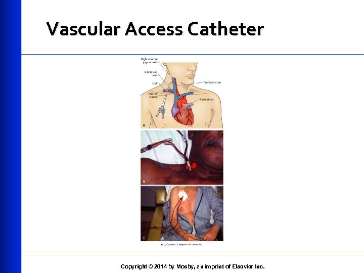 Vascular Access Catheter Copyright © 2014 by Mosby, an imprint of Elsevier Inc. 