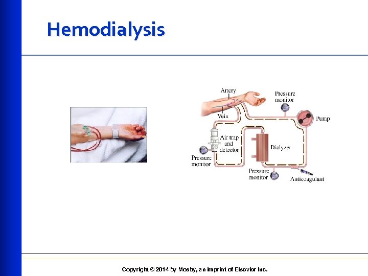 Hemodialysis Copyright © 2014 by Mosby, an imprint of Elsevier Inc. 