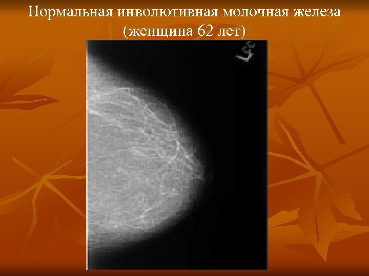Нормальная инволютивная молочная железа (женщина 62 лет) 