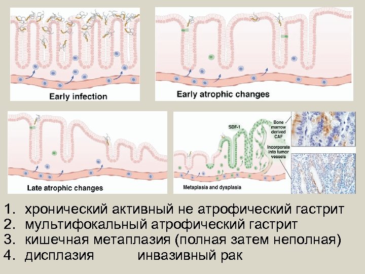 Дисплазия и метаплазия. Кишечная метаплазия желудка гистология. Полная и неполная кишечная метаплазия. Кишечная метаплазия гистология. Неполная кишечная метаплазия желудка.