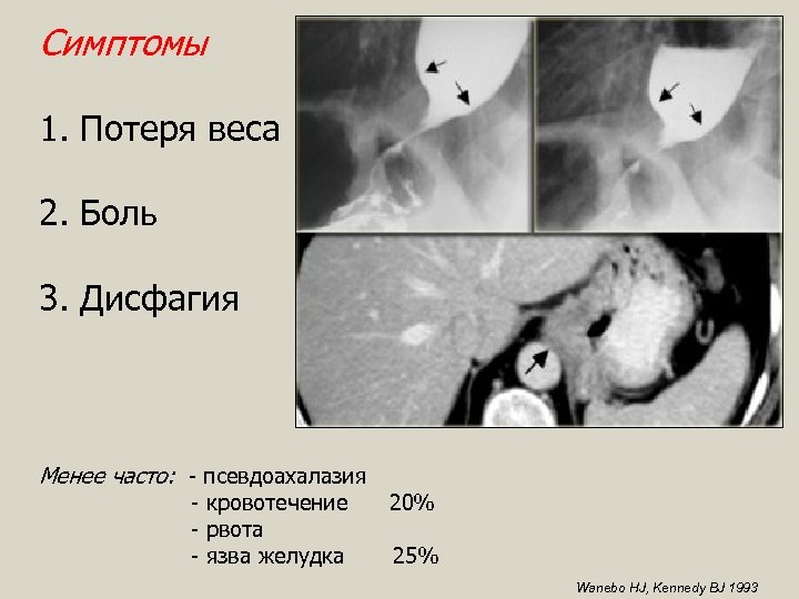 Симптомы 1. Потеря веса 2. Боль 3. Дисфагия Менее часто: - псевдоахалазия - кровотечение