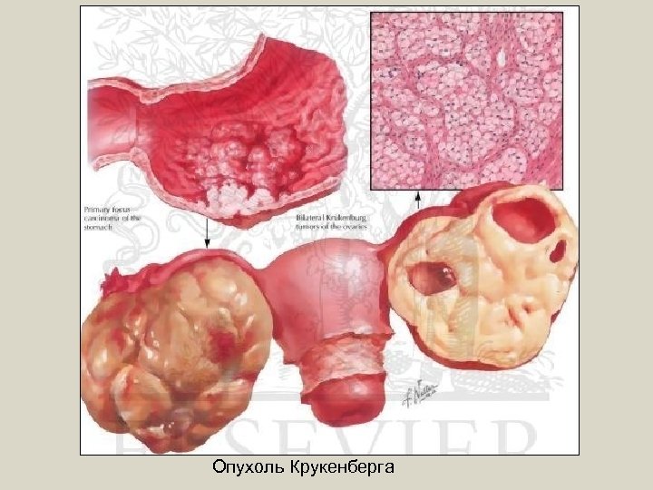 Опухоль Крукенберга 