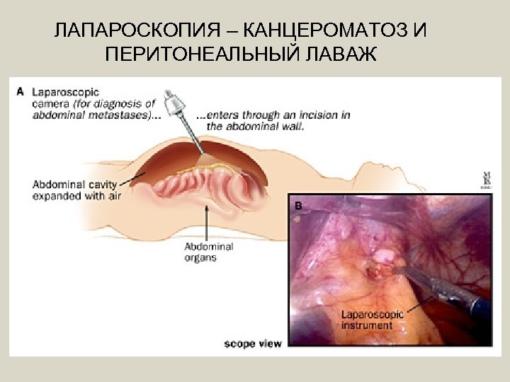 ЛАПАРОСКОПИЯ – КАНЦЕРОМАТОЗ И ПЕРИТОНЕАЛЬНЫЙ ЛАВАЖ 