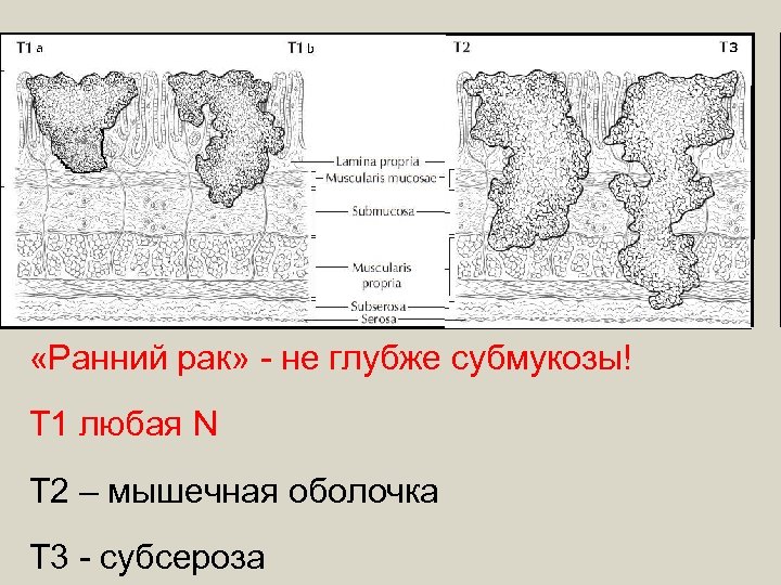  «Ранний рак» - не глубже субмукозы! Т 1 любая N Т 2 –