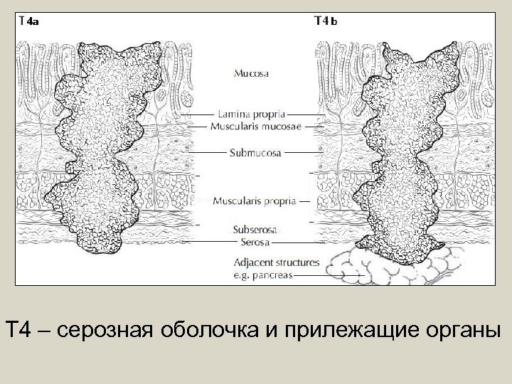 Т 4 – серозная оболочка и прилежащие органы 