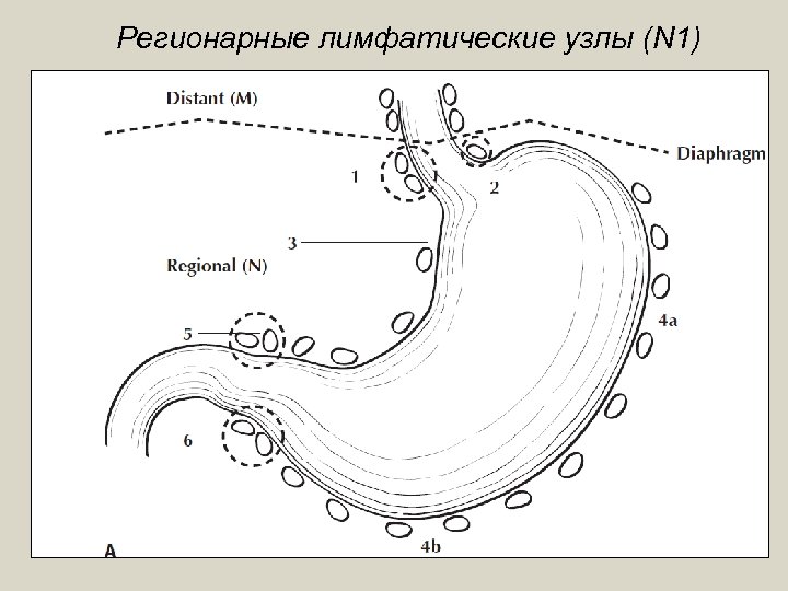 Регионарные лимфатические узлы (N 1) 