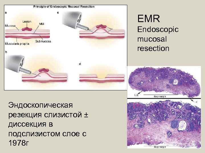 EMR Endoscopic mucosal resection Эндоскопическая резекция слизистой ± диссекция в подслизистом слое с 1978