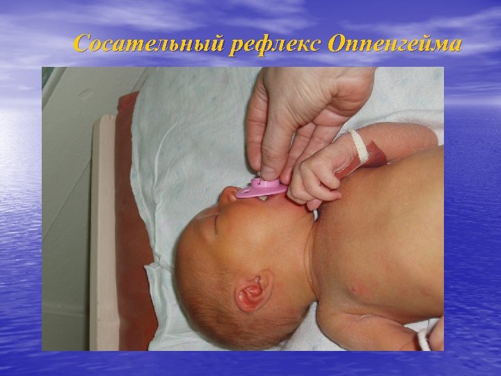 Сосательный рефлекс Оппенгейма 