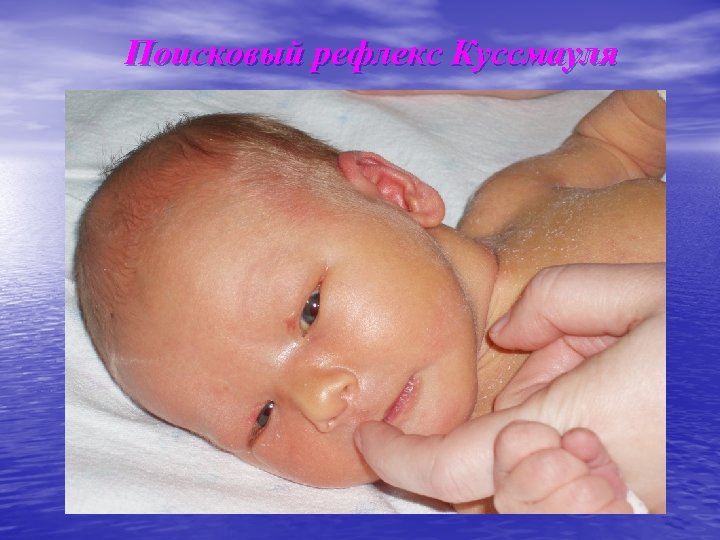 Поисковый рефлекс Куссмауля 