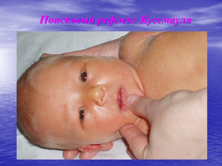 Поисковый рефлекс Куссмауля 