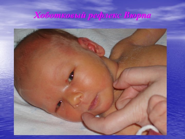 Хоботковый рефлекс Вюрпа 