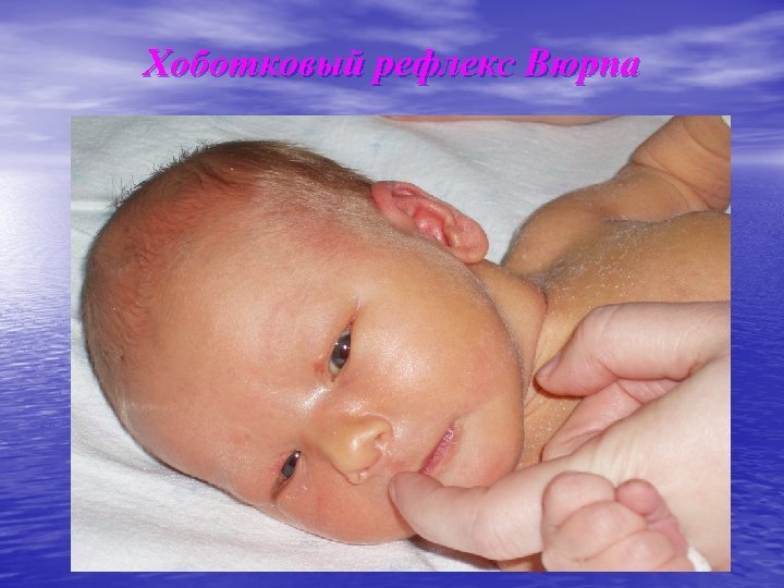 Хоботковый рефлекс Вюрпа 