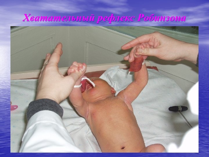 Хватательный рефлекс Робинзона 