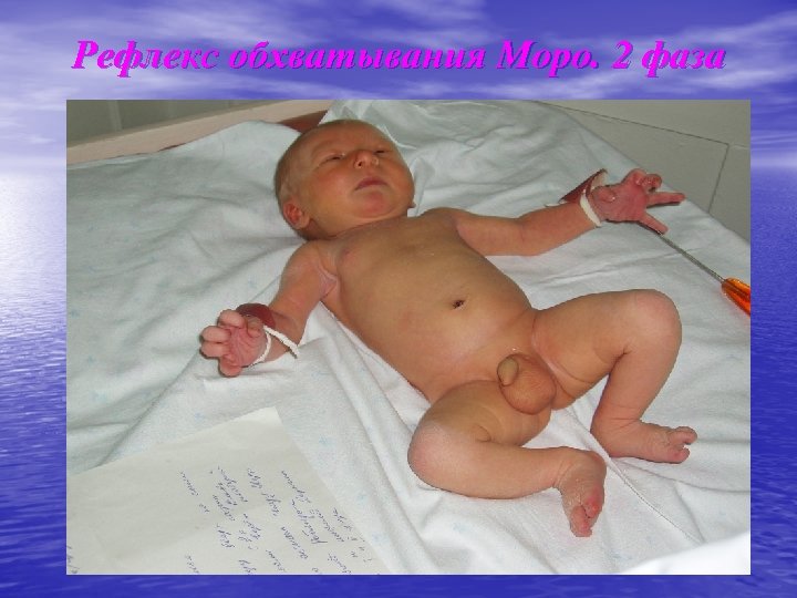 Рефлекс обхватывания Моро. 2 фаза 