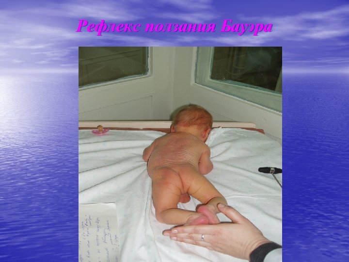 Рефлекс ползания Бауэра 