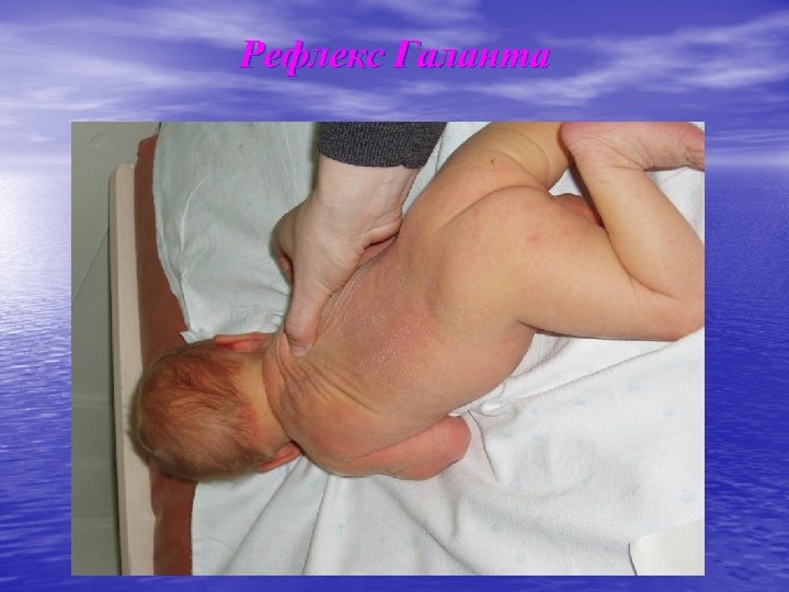 Рефлекс Галанта 