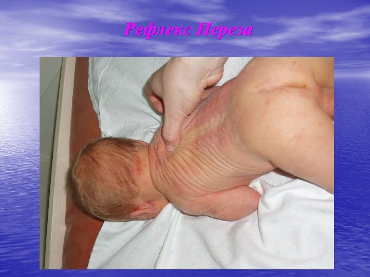 Рефлекс Переза 