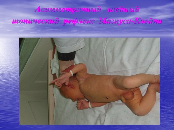 Асимметричный шейный тонический рефлекс Магнуса-Клейна 