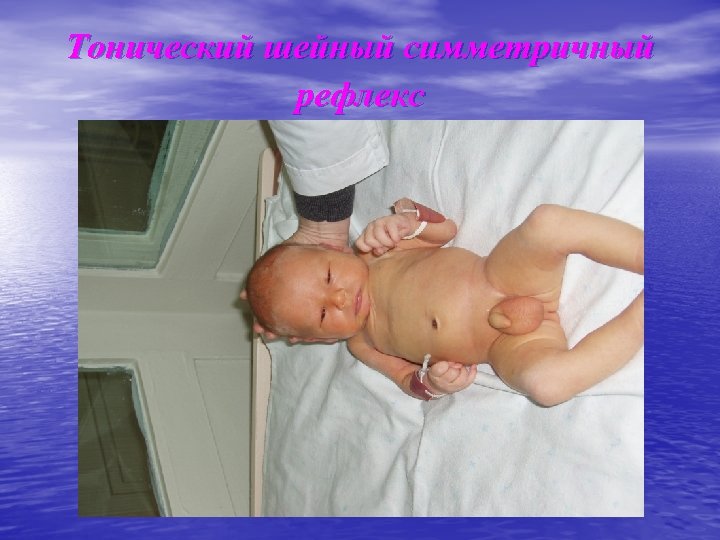 Тонический шейный симметричный рефлекс 