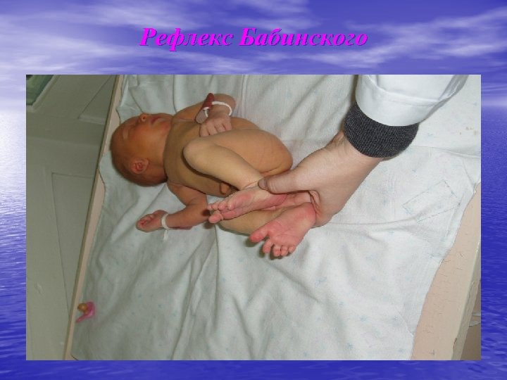 Рефлекс Бабинского 