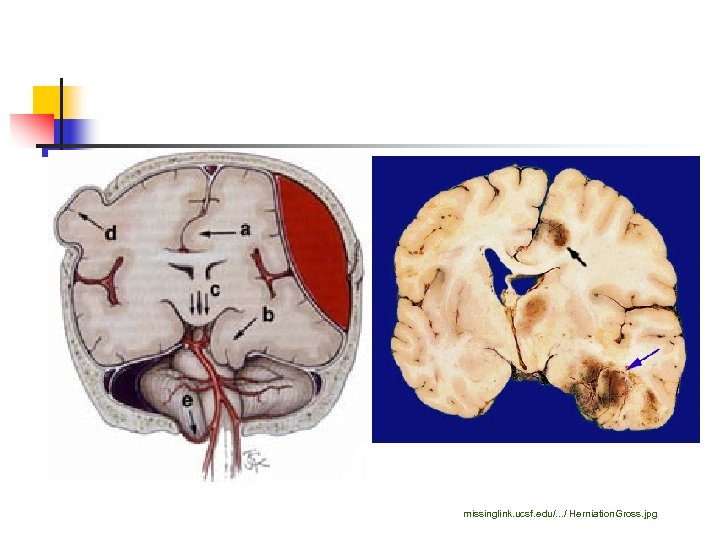 missinglink. ucsf. edu/. . . / Herniation. Gross. jpg 