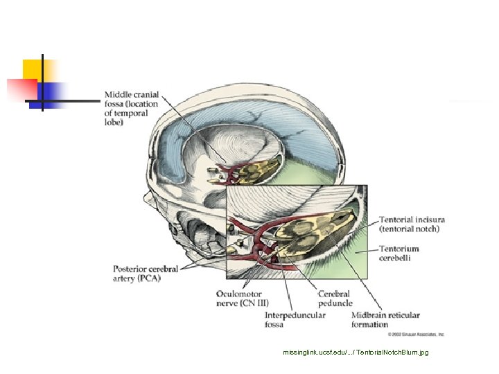 missinglink. ucsf. edu/. . . / Tentorial. Notch. Blum. jpg 