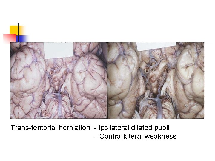 Trans-tentorial herniation: - Ipsilateral dilated pupil - Contra-lateral weakness 