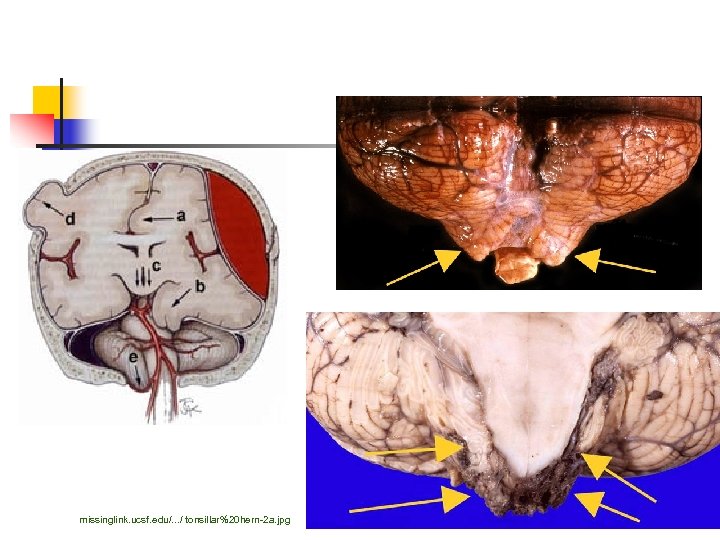 missinglink. ucsf. edu/. . . / tonsillar%20 hern-2 a. jpg 