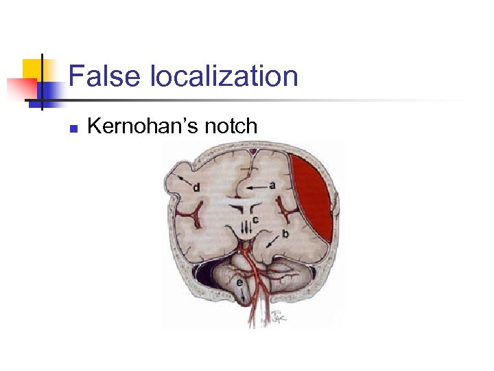 False localization n Kernohan’s notch 