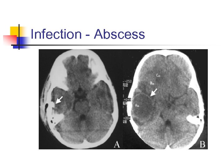 Infection - Abscess 