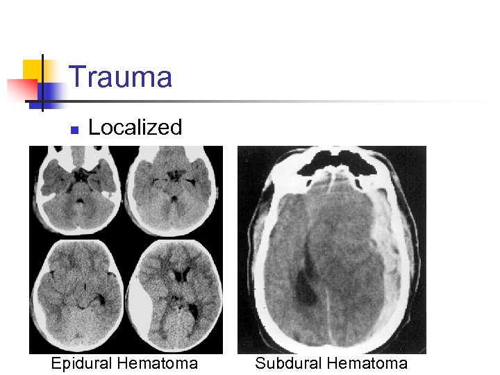 Trauma n Localized Epidural Hematoma Subdural Hematoma 