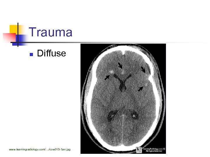 Trauma n Diffuse www. learningradiology. com/. . . /cow 315 -1 arr. jpg 