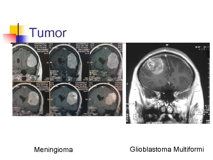 Tumor Meningioma Glioblastoma Multiformi 